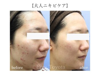 エピア 豊田店(Epia)/大人ニキビケア・赤み痕ケア