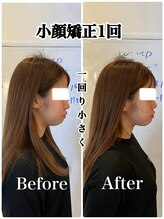 リバイブ 五反田店(REVIVE)/小顔矯正1回