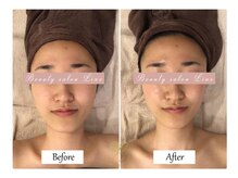 リノ(Lino)/美白エステで内側から輝くお肌♪