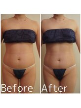 トータルビューティサロン クイーン(Queen)/お腹周りのお肉をスッキリ！