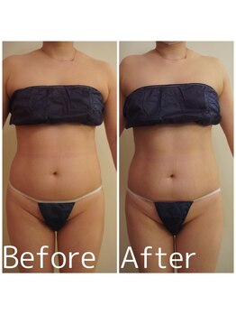 トータルビューティサロン クイーン(Queen)/お腹周りのお肉をスッキリ!