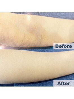 オーシャンブルー 佐世保店(OCEAN BLUE)/結果の出る脱毛【ひじ下】