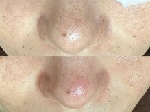 エクラ バイ シャンリィ(eclat by shanLy)/毛穴ケア