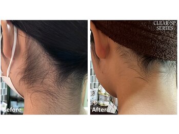 セラス(CERAS)/女性えりあし脱毛