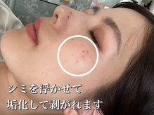 ハービー(Herbee)の雰囲気（施術効果はブログに！シミケアで浮かせて垢化します！）
