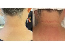 デンドロビューム(Dendrobium)/SPハーブピーリング1回施術