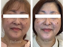 ブルースター/BeforeAfter(50代）