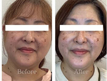 ブルースター/BeforeAfter(50代)