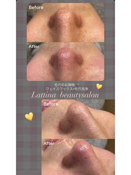 ラティーナ(Lattina)/毛穴洗浄×艶肌ワックス