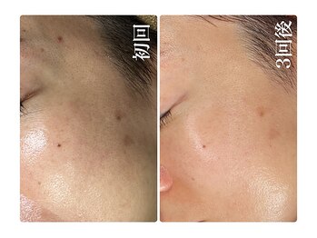 キレイ(KIREI)/初回→3回後