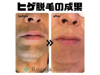 レジーナビューティー(Regina Beauty)/驚異のビフォーアフター