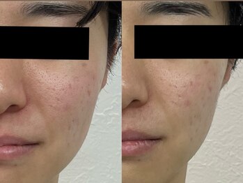 リノア 堀江(Linoa)/毛穴・赤み