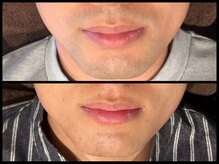 1番人気のひげ脱毛