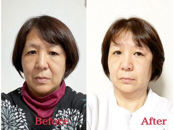 シルフィード/目が開き若々しくなりました