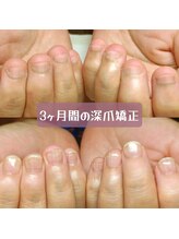 マニエネイル(mani e nail)/3ヶ月間の深爪矯正～美爪育成へ