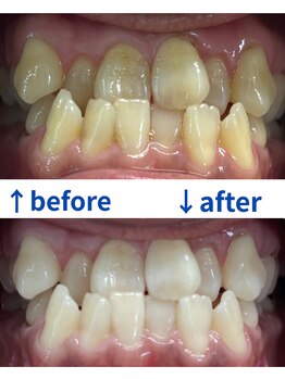 ホワイトマジック(White Magic)/before→after