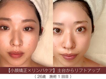 ホワイトカメリア(White Camellia)/【小顔矯正】持続するリフト