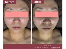 ウェルネス ステーション リンク(Wellness Station Link)の雰囲気（１回の施術でもこの違い。フェイスライン、ハリ・つやにご注目！）