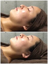 アネル 豊見城(anel)/３D超音波リフト