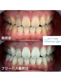 ホワイトニングサロン 熊本店/いつでもセルフホワイトニング