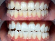 ライトケアサロン 表参道店(Light Care Salon)/セルフホワイトニング