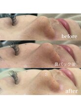 ラクシー 御徒町(luxssy)/3D毛穴洗浄