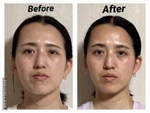 ショウフェイスデザイン(Sho Face Design)/《小顔矯正》ビフォーアフター