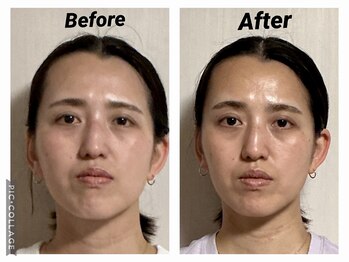 ショウフェイスデザイン(Sho Face Design)/《小顔矯正》ビフォーアフター