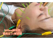 エムハナ鍼灸院(M.hana鍼灸院)の雰囲気（【美容鍼】リフトアップ、しわ、たるみ、肌質改善に最適です！）