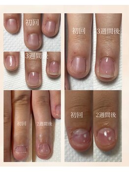 ハンド ケイ(Hand K)/自爪育成