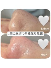 ユニ(uni.)/毛穴エクストラクション