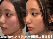 メイクでダウンタイムも目立たなくなるのでお仕事されてる方も◎