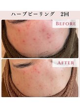 レクラ バイ ドクターエイチ(L'ECLAT by Doctor.H)/ハーブピーリング