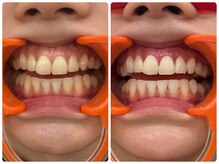 コナホワイトニング 神保町/セルフホワイトニング神保町