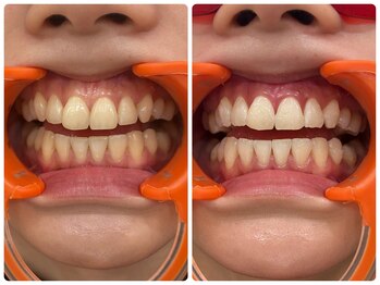 コナホワイトニング 神保町/セルフホワイトニング神保町