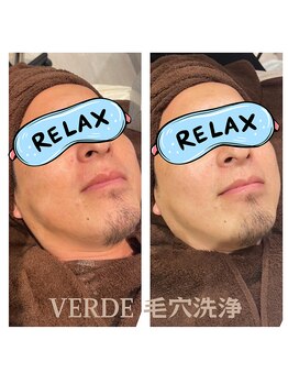 ヴェルデ 八尾/炭酸泡パックのビフォーアフター