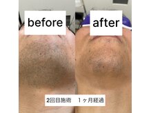 ラウラウ(laulau)の雰囲気（ヒゲ脱毛には自信があります！）