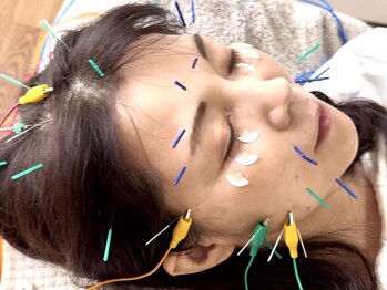 ピーチ鍼灸整体治療院(Peach鍼灸整体治療院)の写真/《大人気★》本格美容鍼でリフトアップ・ほうれい線・たるみにお悩みの方に◎