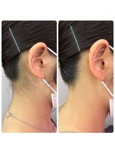 アーヒル(A”-HILU)/うなじ脱毛