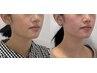 【輪郭が変わる感動体験を】美容鍼＋エラ矯正☆小顔/左右差¥107250→¥16500