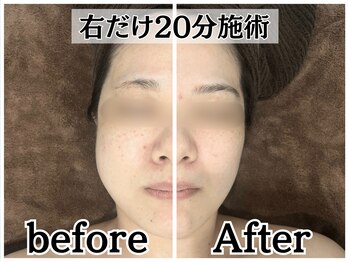 イデアルボーテ/初回から速攻小顔リフトアップ