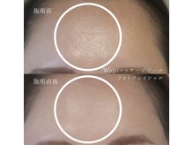 ビズビズ 梅田店(bisebise)の雰囲気（new医療級の施術☆1回でも激変!マッサージピール+重ね打ちフォト）