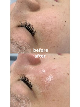 セレネ(SELENE)/乾燥、シワ、小皺のお悩み