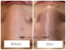 スキンセラピーサロン ル クレール(Le Clair)の雰囲気（頑固な毛穴も、剥けないハーブピーリングでスッキリ！）