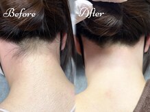 ピミル(PIMIL)/うなじ脱毛