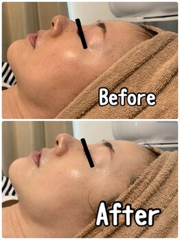 ブランシュール/ハイドラ×ヒト幹細胞導入