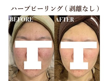 ティアム バイ テトテ 神戸三宮(TIAM by tetote)/ハーブピーリング 剥離無し