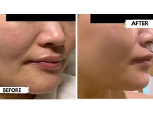 ロロメ(Rorome)/ビフォー/アフター(ニキビ)