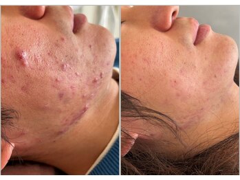 ナンバーナイン(No.9)/ニキビケア・毛穴ケア