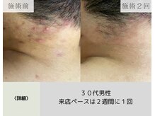 ボータン 恵(Beau Temps)/ハーブピーリング